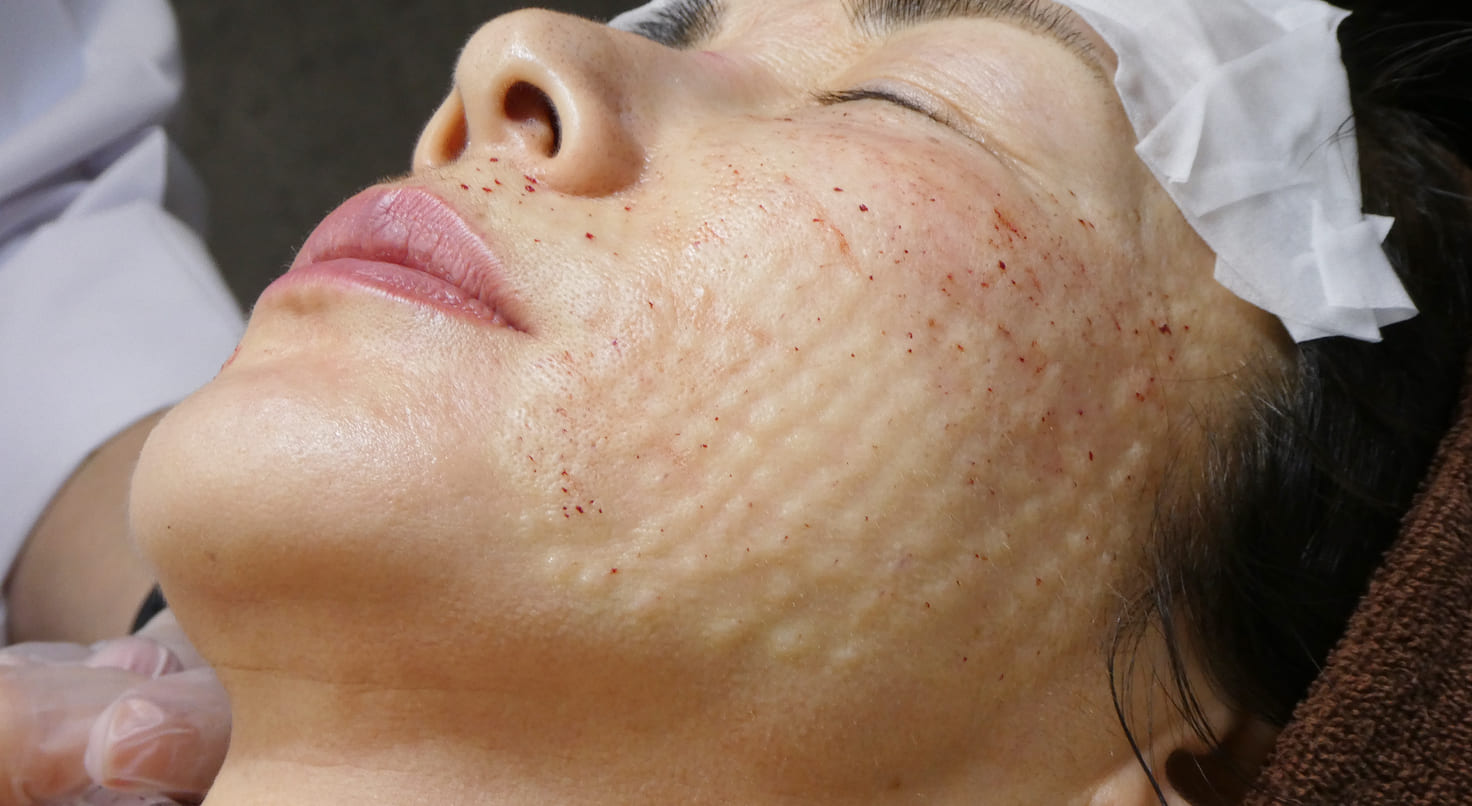 肌細胞移植（1回目・2回目）