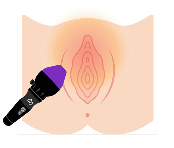 Alma Duoの施術イメージ