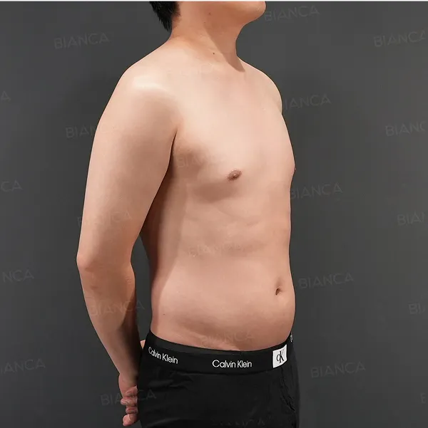 Mounjaro after in the Abdomen and Waistline