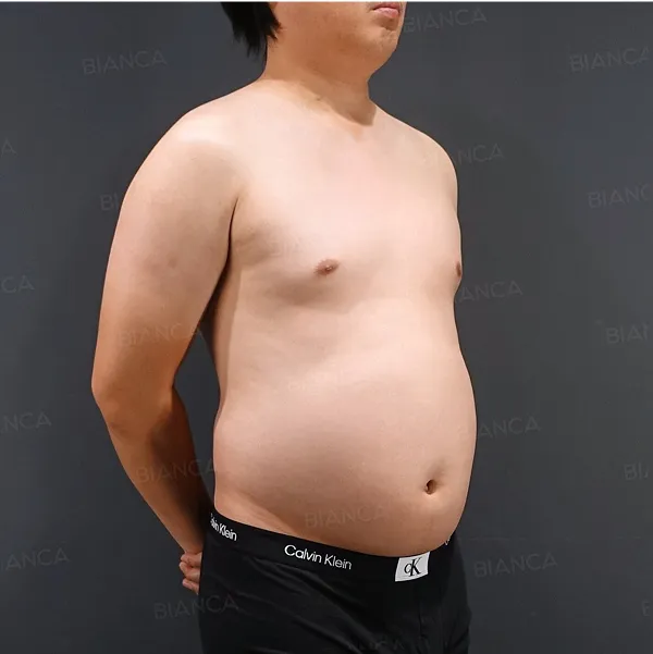 Mounjaro before in the Abdomen and Waistline