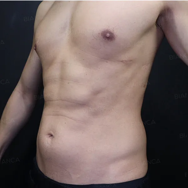 Mounjaro after in the Abdomen and Body Contour