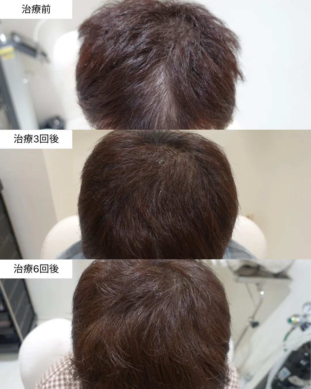 発毛・発育注射の症例写真・施術前後