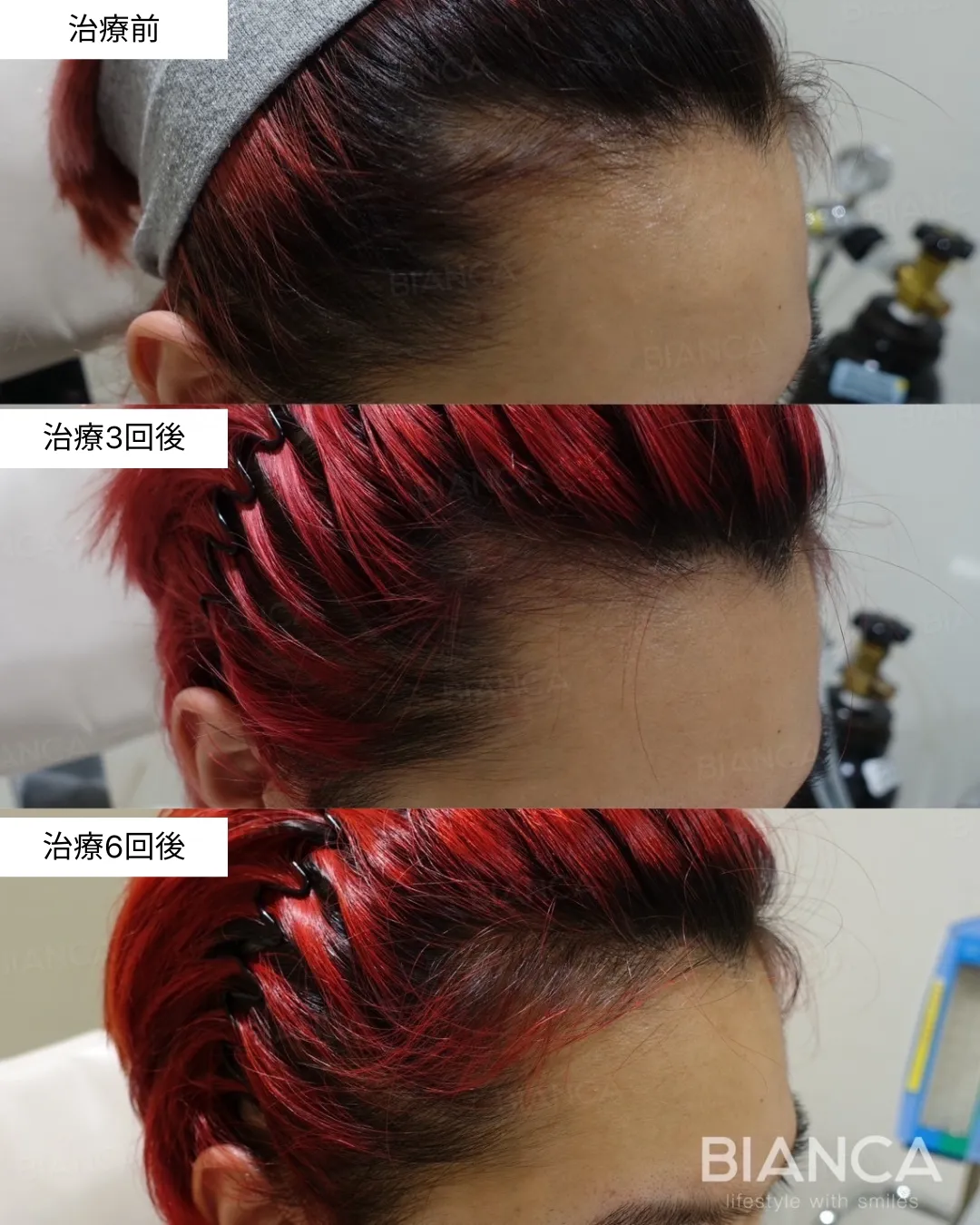 発毛・発育注射の症例写真・施術前後