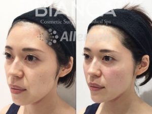 ヒアルロン酸による若返り