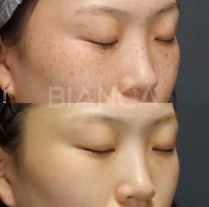 pico spot（ピコスポット）ピコトーニングによるそばかす治療の症例写真