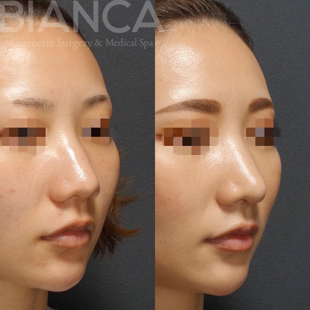 耳介軟骨移植とは