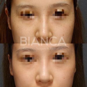 ピコシュアを用いたピコスポット＋ピコトーニングによるシミそばかす・美肌施術症例