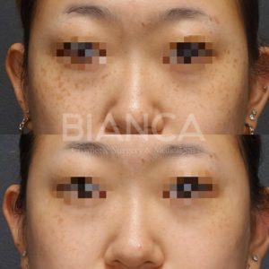 picosure（ピコシュア）を用いたピコスポット全顔によるそばかす治療症例