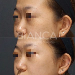 picosure（ピコシュア）を用いたピコスポット全顔によるそばかす治療症例