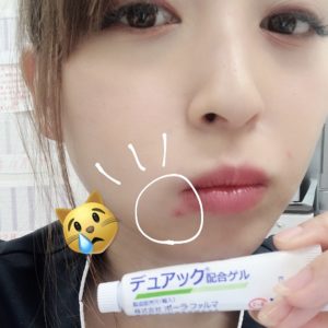 ニキビ治療に皮膚科で処方-デュアックを紹介する大久保由有医師