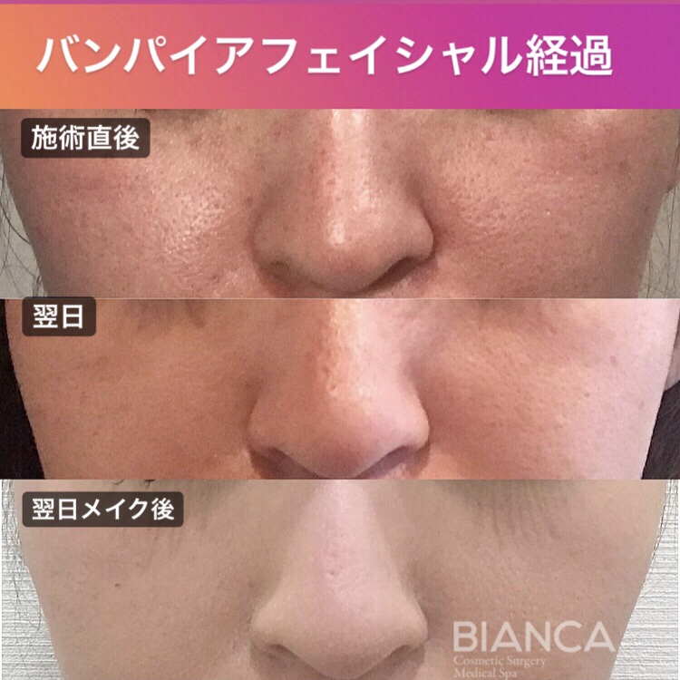 Vampire Facial ダウンタイム&その後の経過あれこれ🧛‍♀️✨