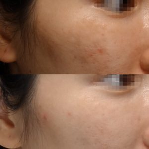 ピコシュア（ピコレーザー）によるADM治療の症例写真