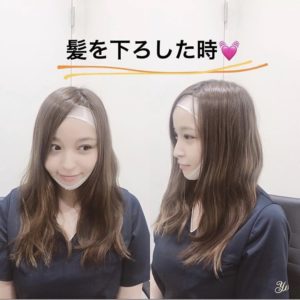 大久保由有医師の脂肪吸引ダウンタイム解説-フェイスバンド着用して髪おろしている