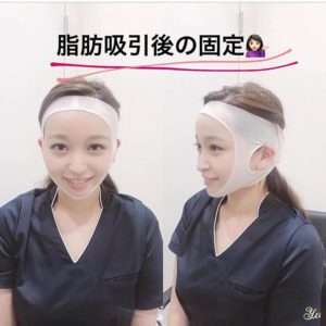 大久保由有医師の脂肪吸引ダウンタイム解説-フェイスバンド着用
