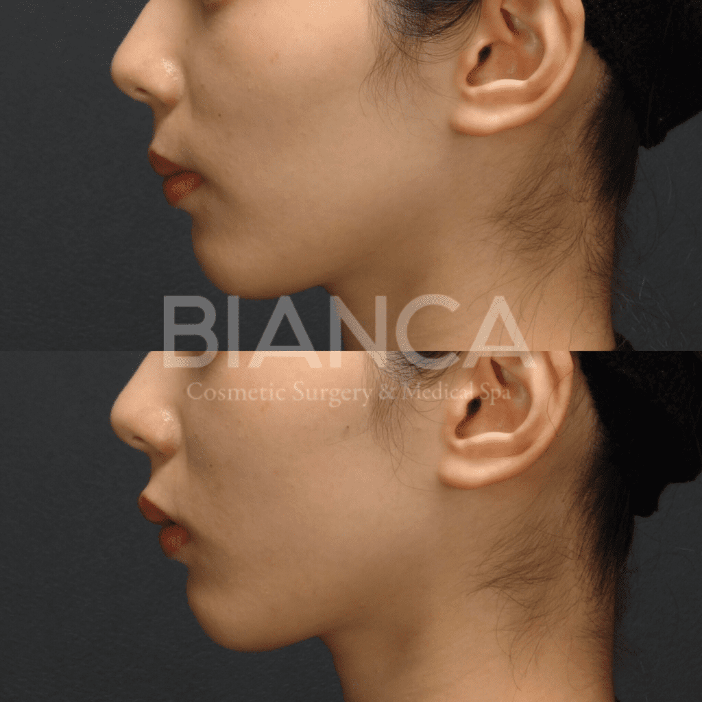 ヒアルロン酸で頬こけにアプローチ！症例や経過、持ちも解説