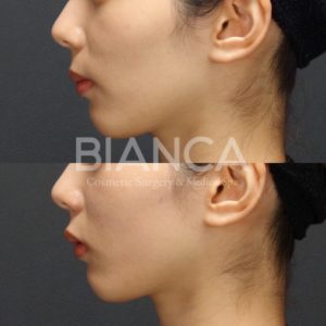 ヒアルロン酸注射_症例_頬こけ_左