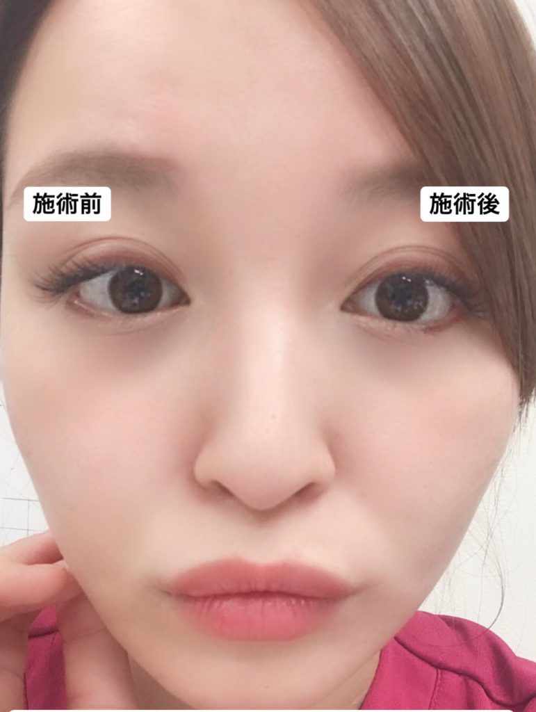 アーモンドアイボトックス受けてみた！グラマラスライン形成との違いは？【医師解説】