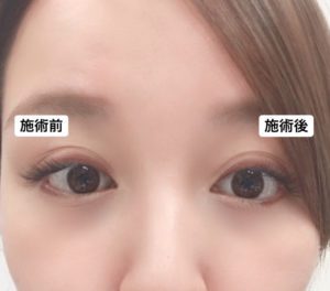 アーモンドアイボトックスの症例