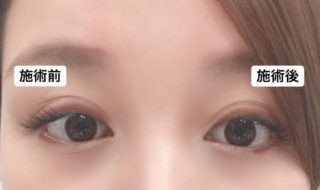 アーモンドアイボトックスの症例