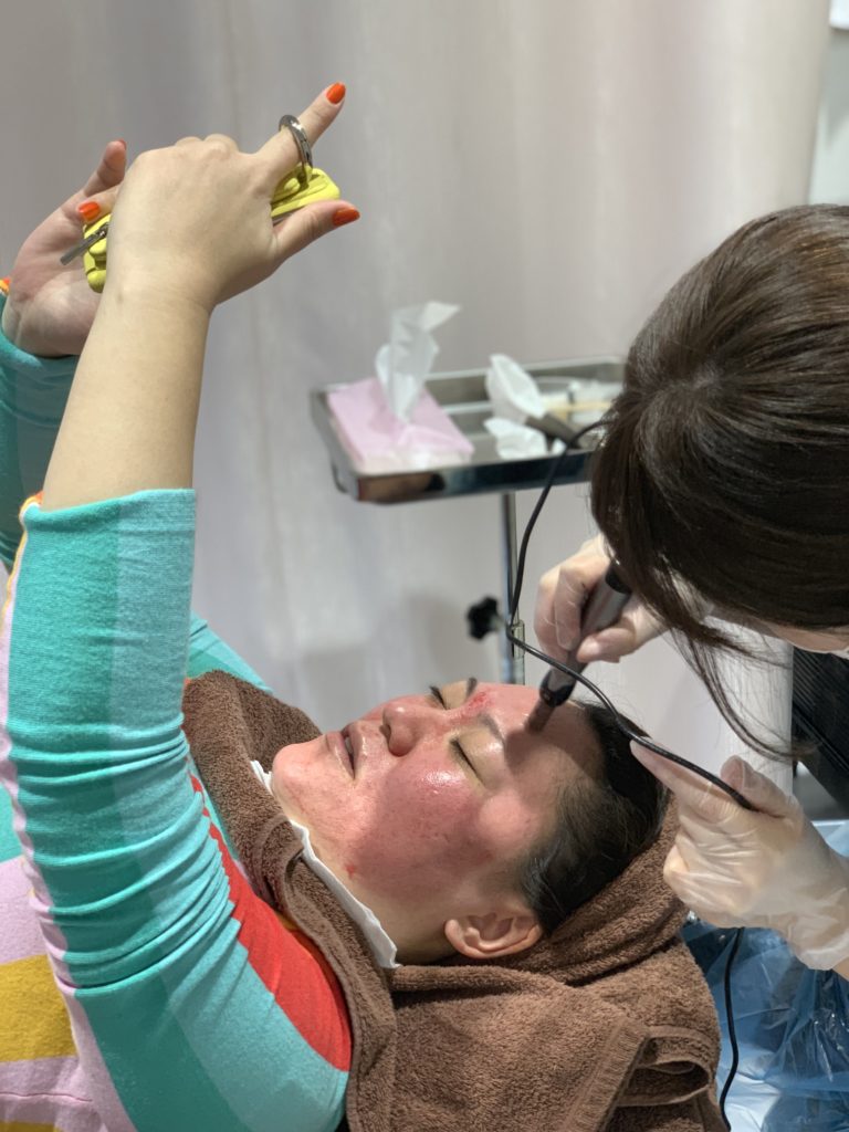 バービーさんがヴァンパイアフェイシャル体験！