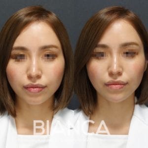 顎ヒアルロン酸注射×顎ボトックスの症例写真