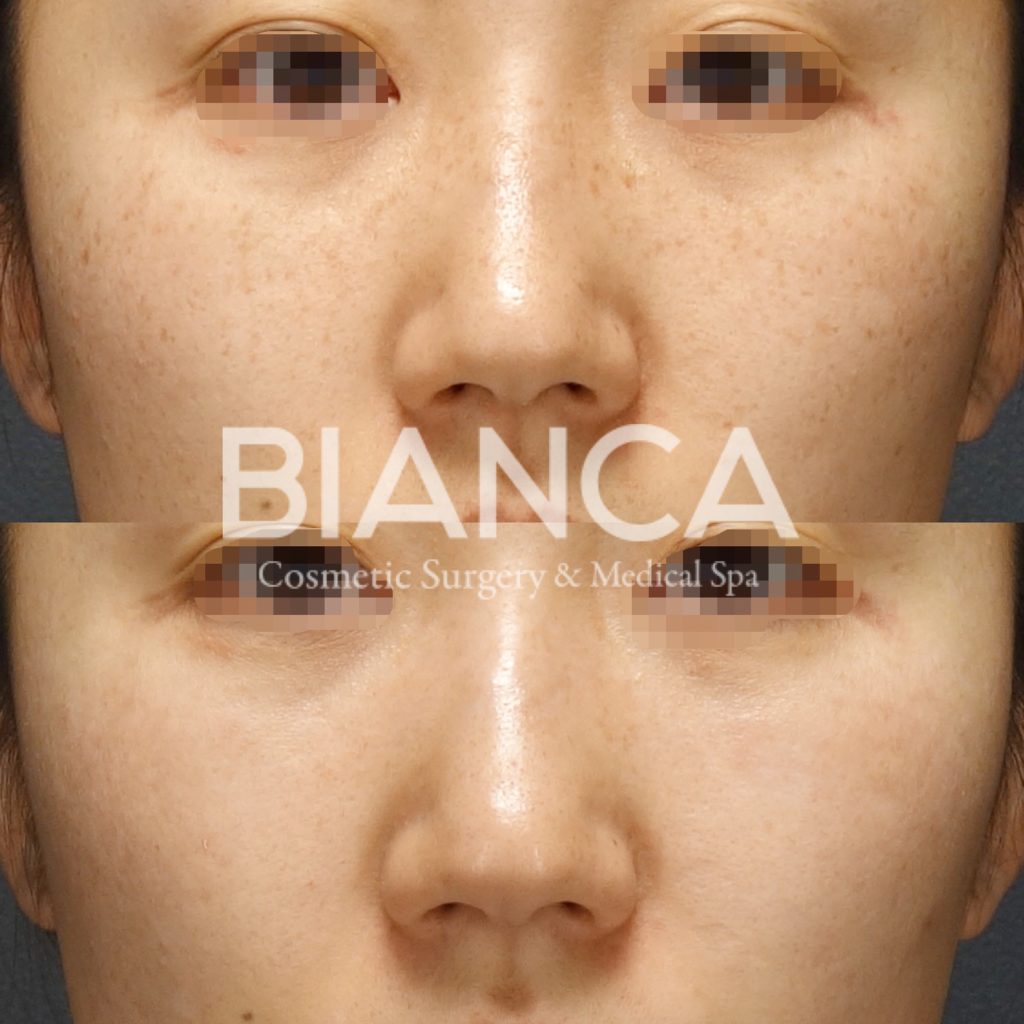 ピコシュア💫スポット照射後の症例写真🤳💘