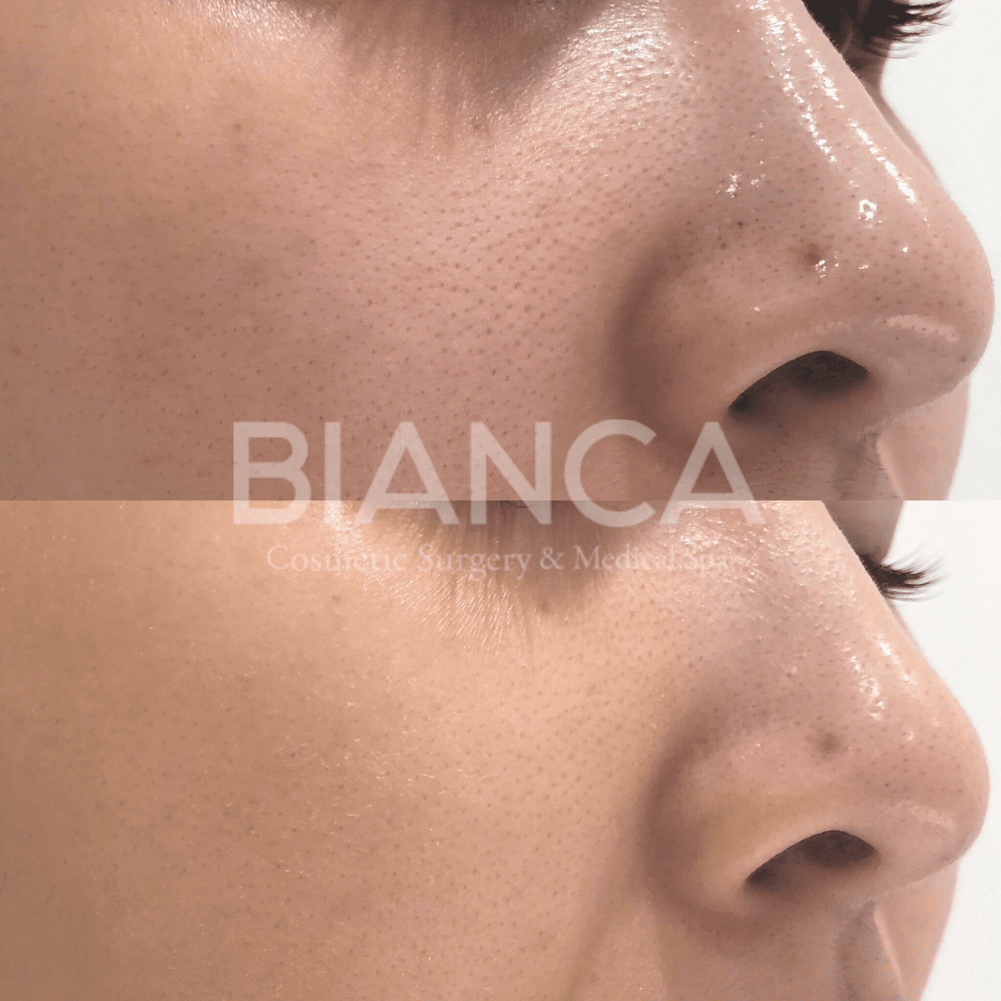 新治療！BotoxFacial！