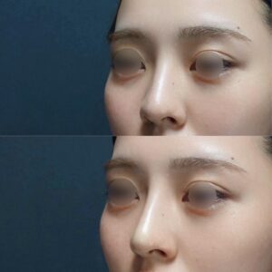 ヒアルロン酸(鼻先、鼻筋)ビアンカクリニック