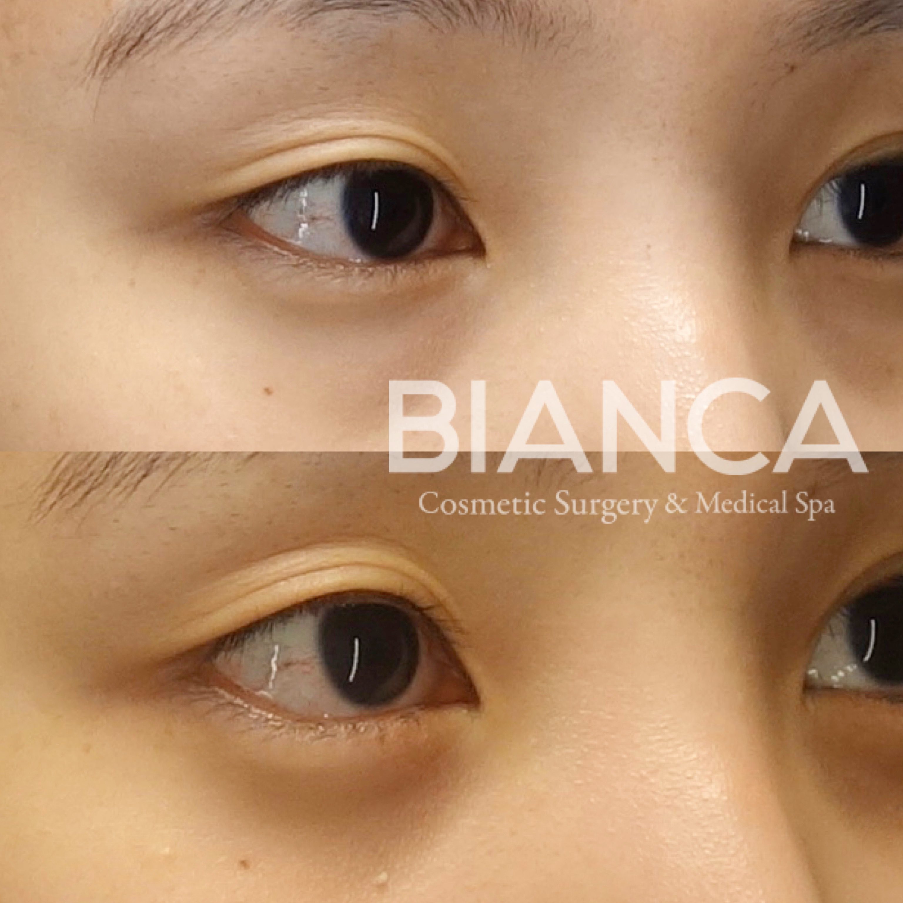 グラマラスライン形成（下瞼開大術）でたれ目に整え、目の縦幅を大きくした症例写真・ビフォーアフター