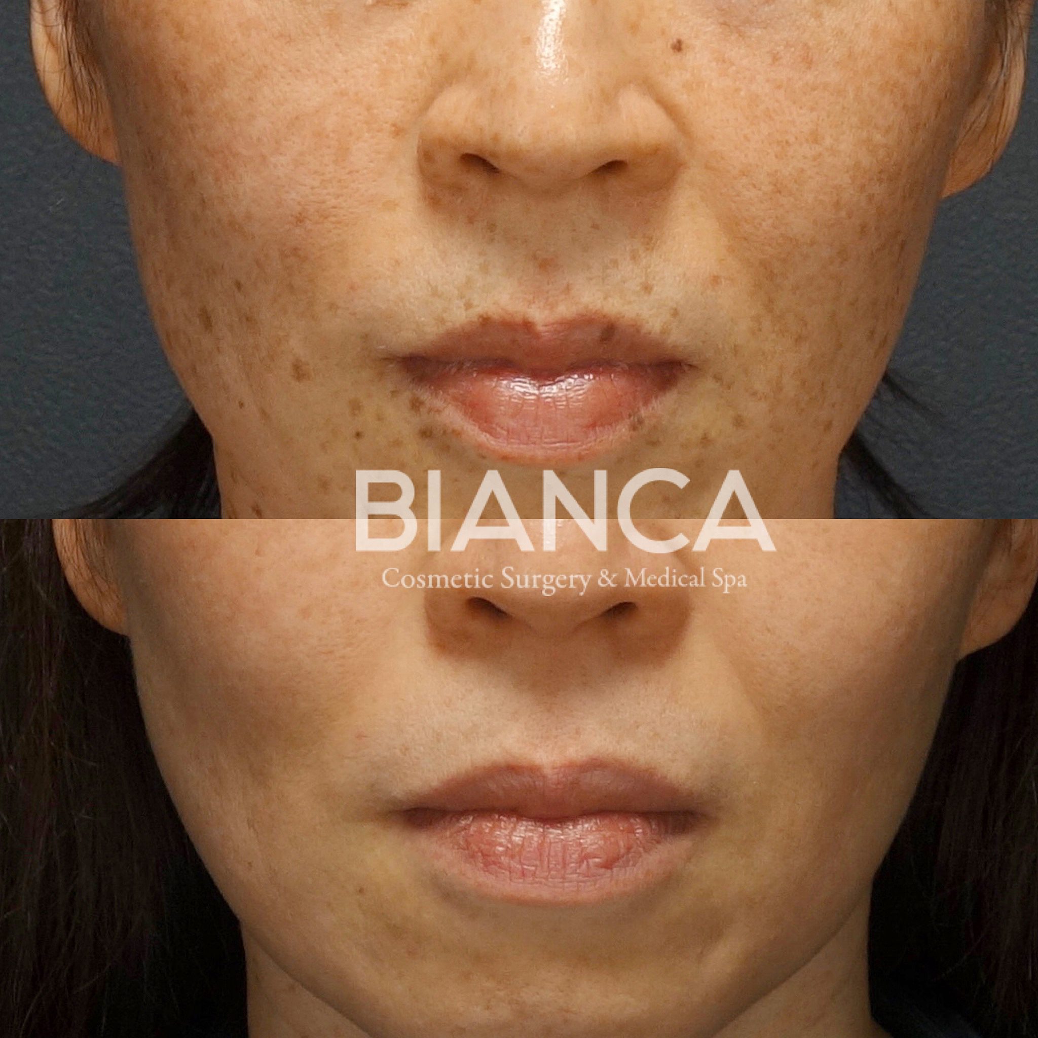 ピコシュアを用いたPICO SPOT（ピコスポット）＋ピコトーニング）によるシミ・そばかす治療の症例写真