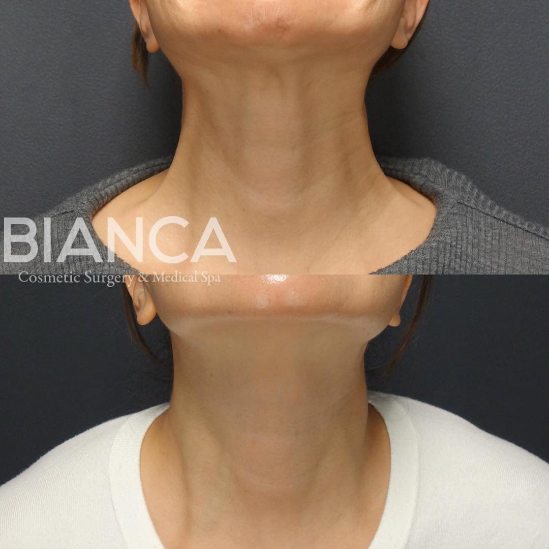 ネックボトックス💉首の縦じわ除去&リフトアップ効果も✨