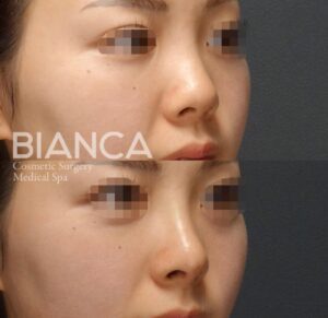 鼻筋・鼻先ヒアルロン酸-ビアンカクリニック