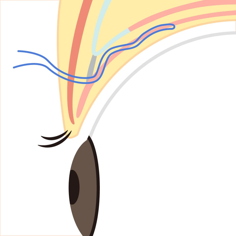 切らない眼瞼下垂手術👀タッキング法👩‍⚕️