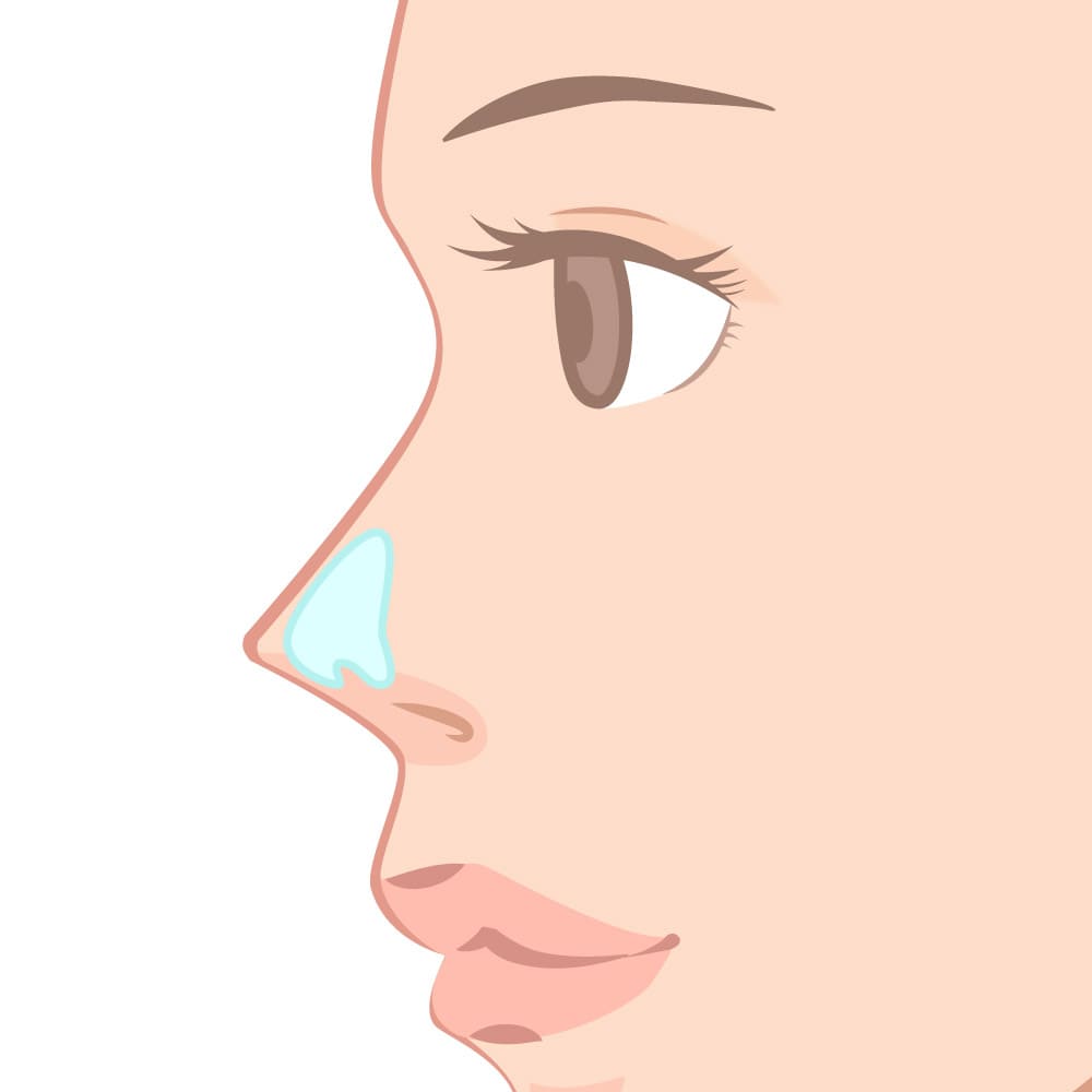 鼻整形👃耳介軟骨移植💐モニター募集中✨