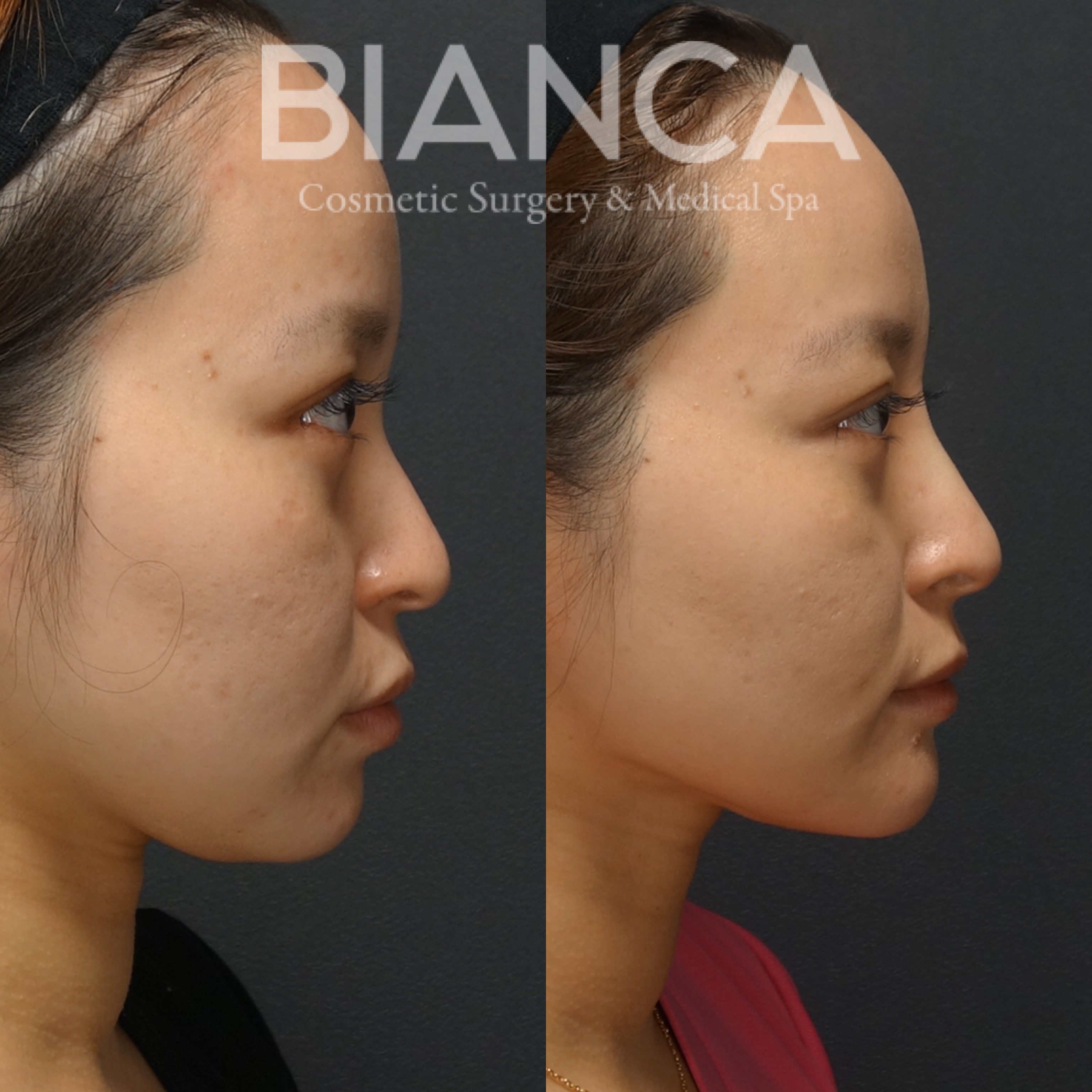 フェイスライン脂肪吸引×糸リフト（スレッドリフト）×バッカルファットによる小顔治療症例写真・ビフォーアフター