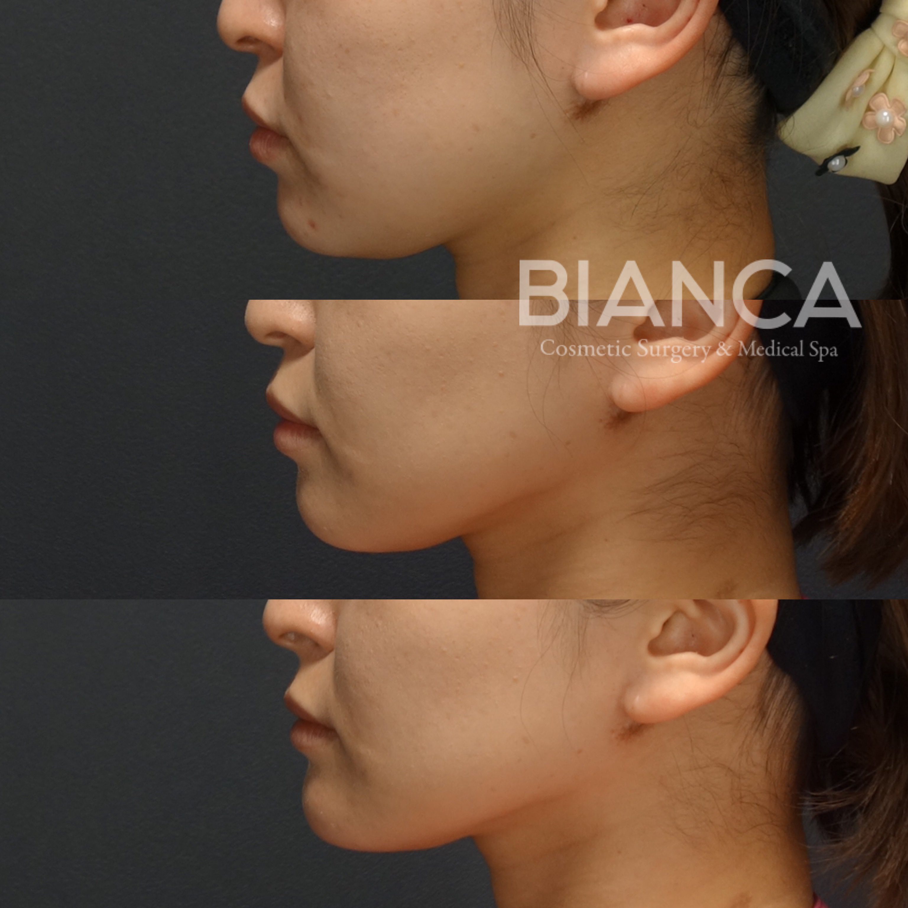 フェイスライン脂肪吸引×糸リフト（スレッドリフト）×バッカルファットによる小顔治療症例写真・ビフォーアフター