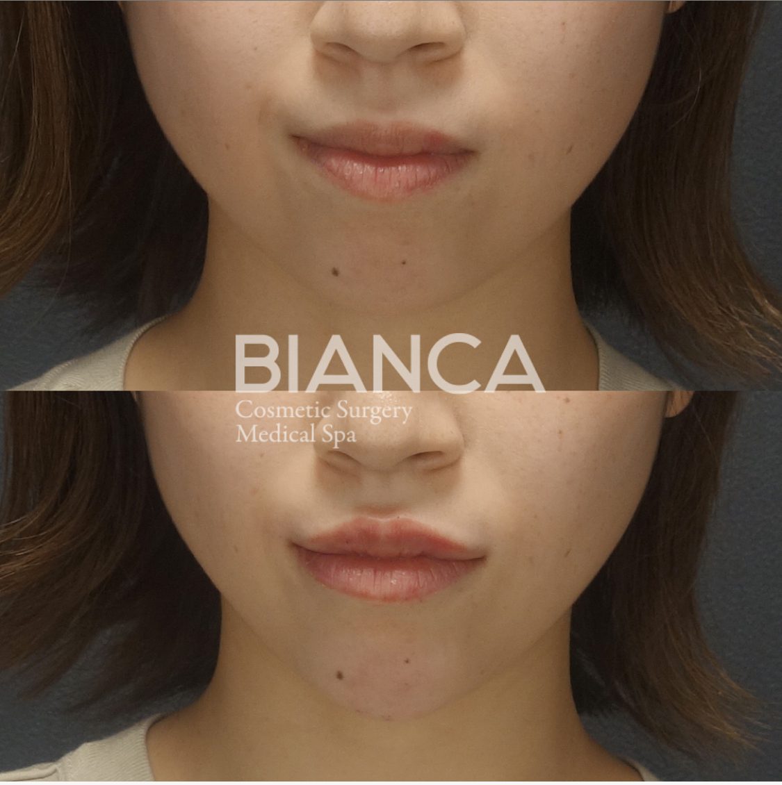 口角を上げたい！唇ヒアルロン酸で柔らか上品リップ