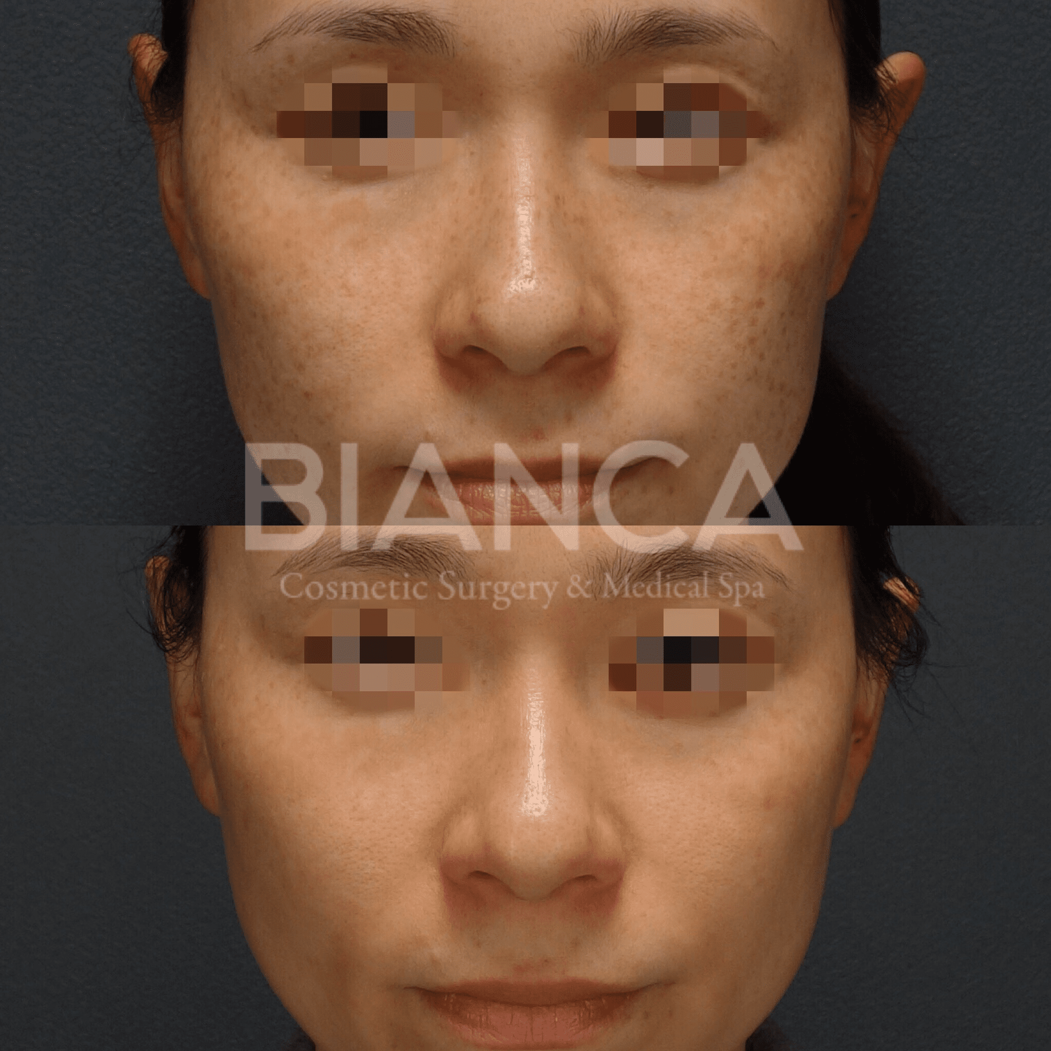 PicoSure（ピコシュア）シミ・そばかす症例まとめ｜これぞBIANCAメソッド✨