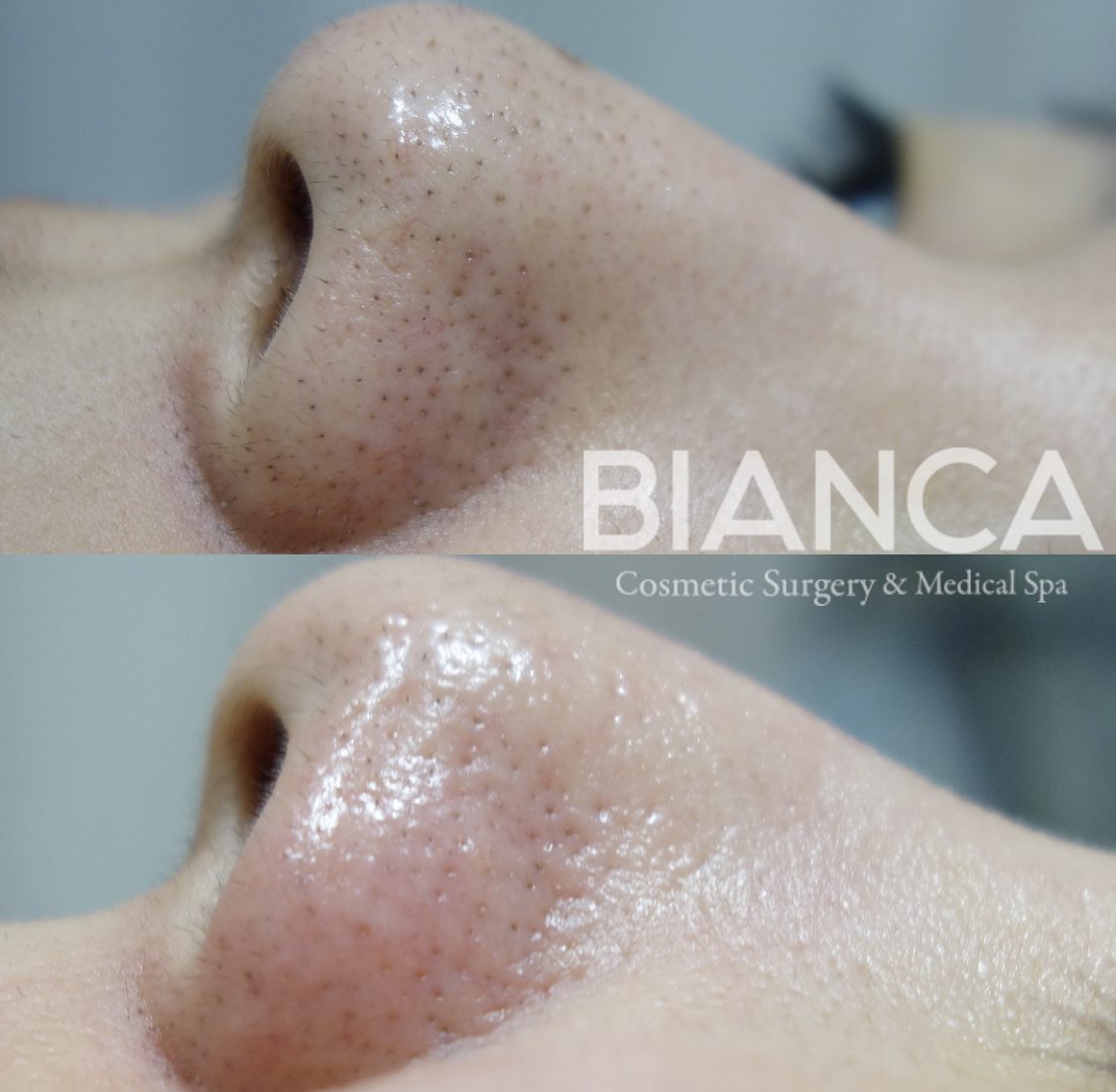 ハイドラフェイシャル（Hydrafacial）による毛穴の汚れ・角質除去・肌質改善の症例写真・ビフォーアフター