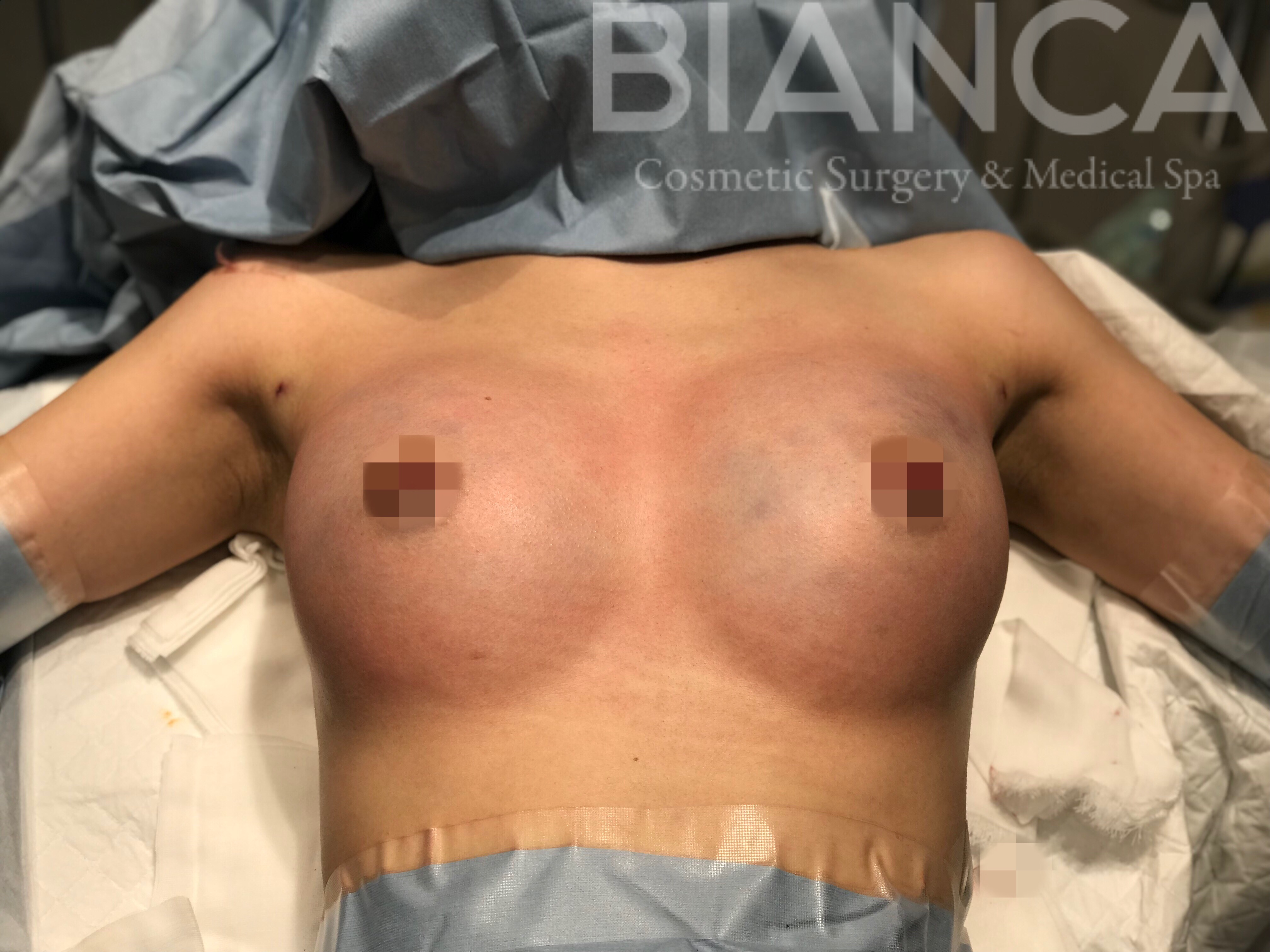 GWは連日豊胸です！