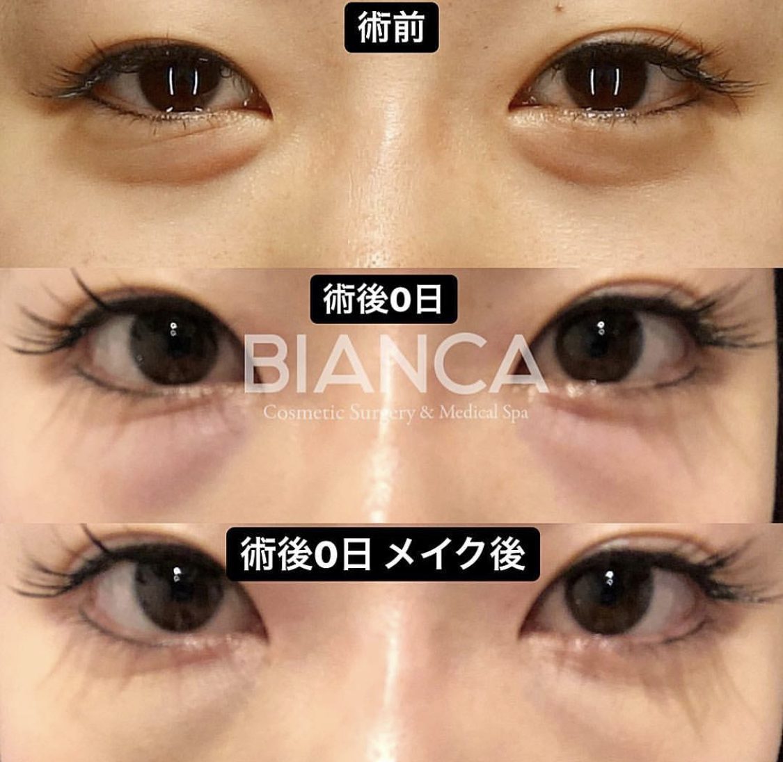 目の下クマ・たるみ取り（経結膜脱脂術）の症例紹介！ダウンタイム経過は？