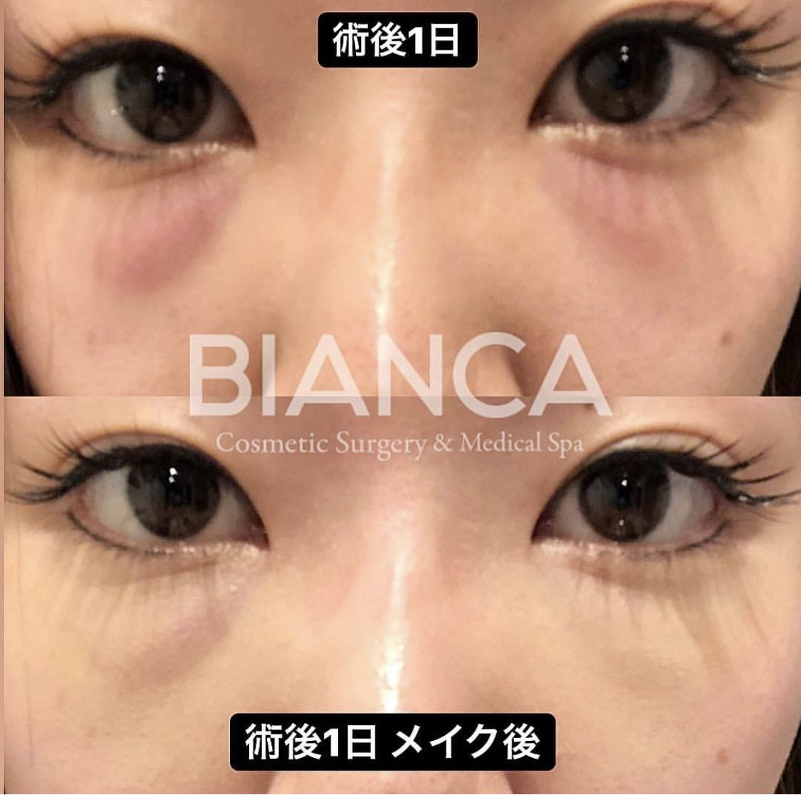 目の下クマ・たるみ取り（経結膜脱脂術）の症例紹介！ダウンタイム経過は？