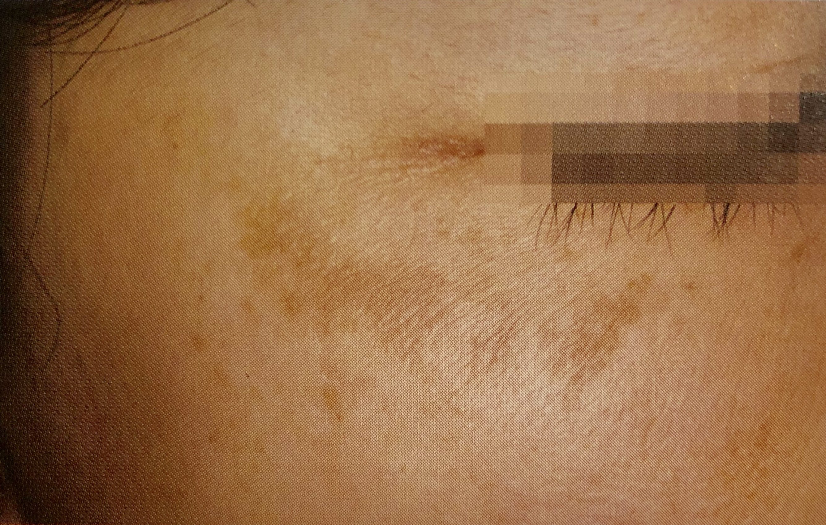 肝斑とは？特徴や原因、治療法をビアンカドクターが解説