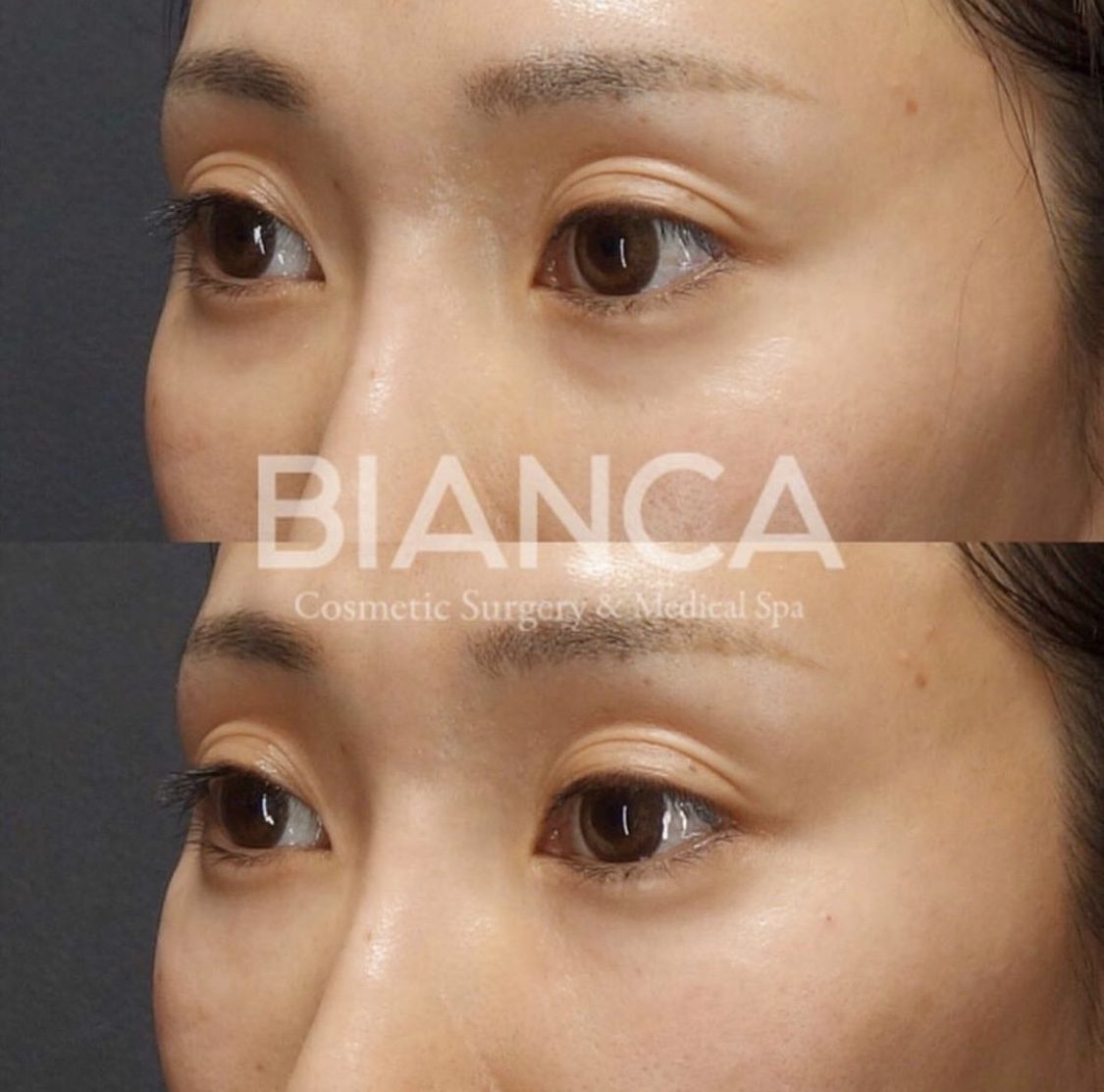 目の下の悩みにベビーコラーゲン！くぼみ・ちりめんジワを自然に整える注入治療【ビアンカクリニック】