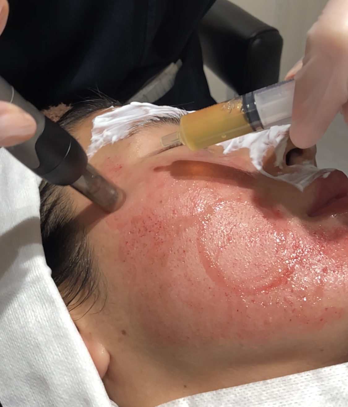 ヴァンパイアフェイシャル🧛‍♀️🦇