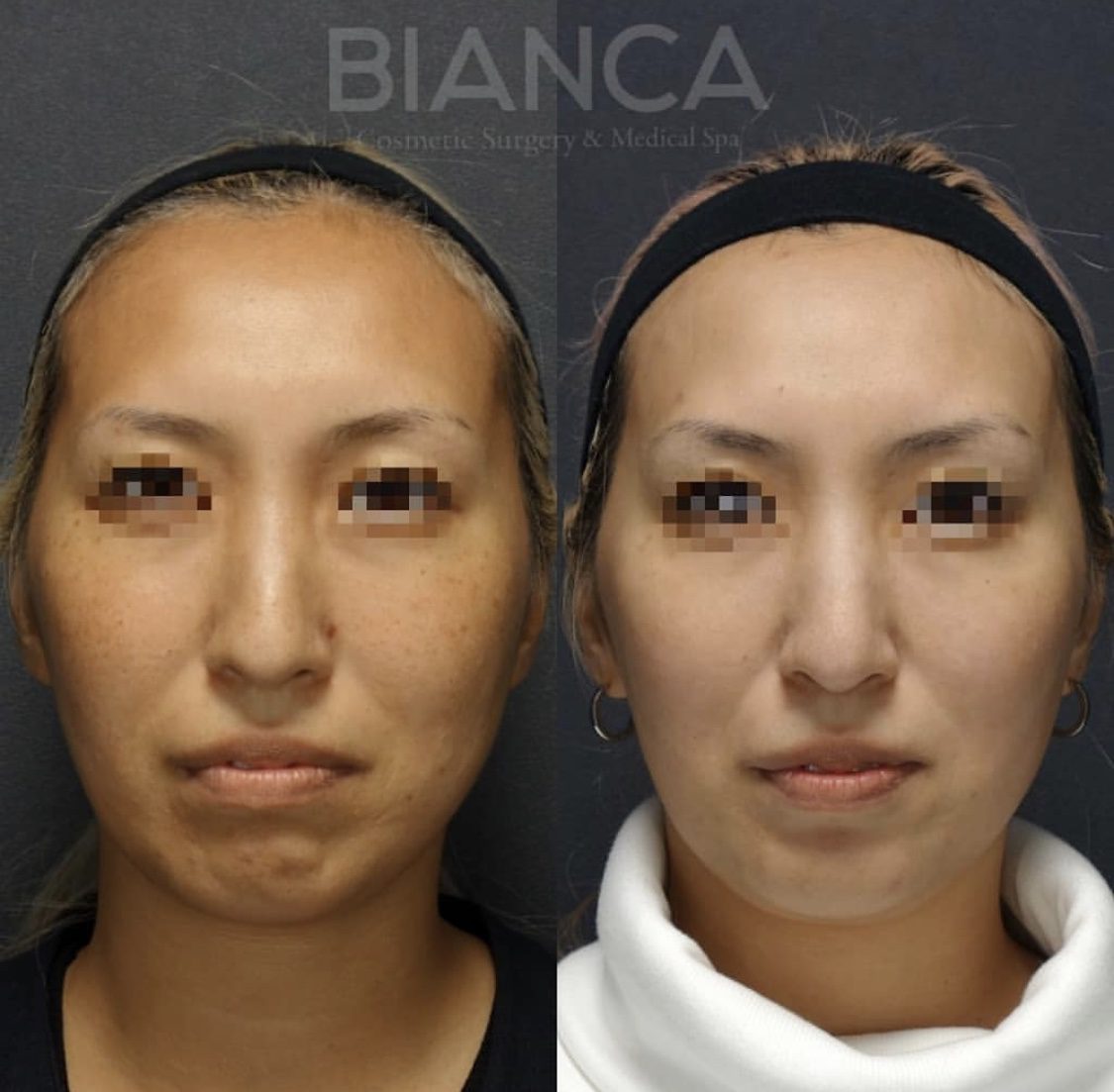 pico spot（ピコスポット）・ピコトーニングによる美白治療の症例写真