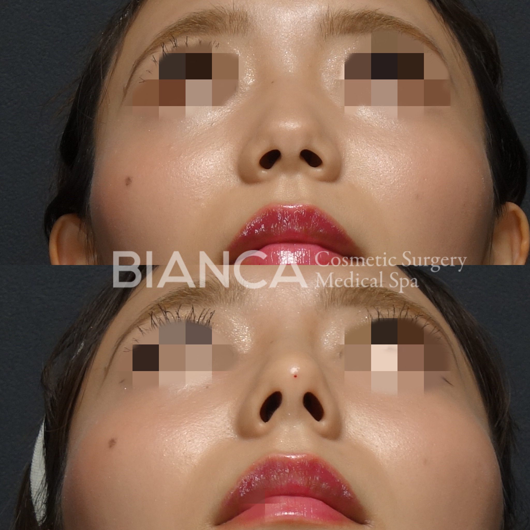 鼻が低い…ヒアルロン酸注射でナチュラルに洗練！【症例紹介】