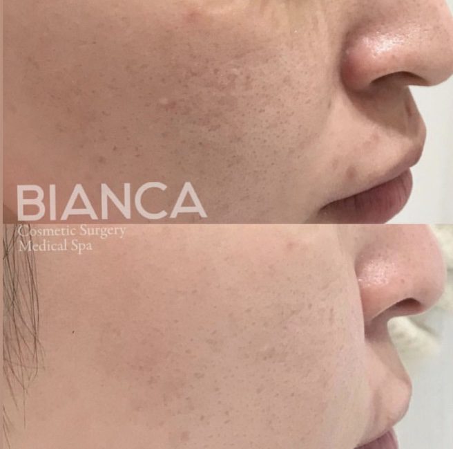 ヴァンパイアフェイシャルの効果！