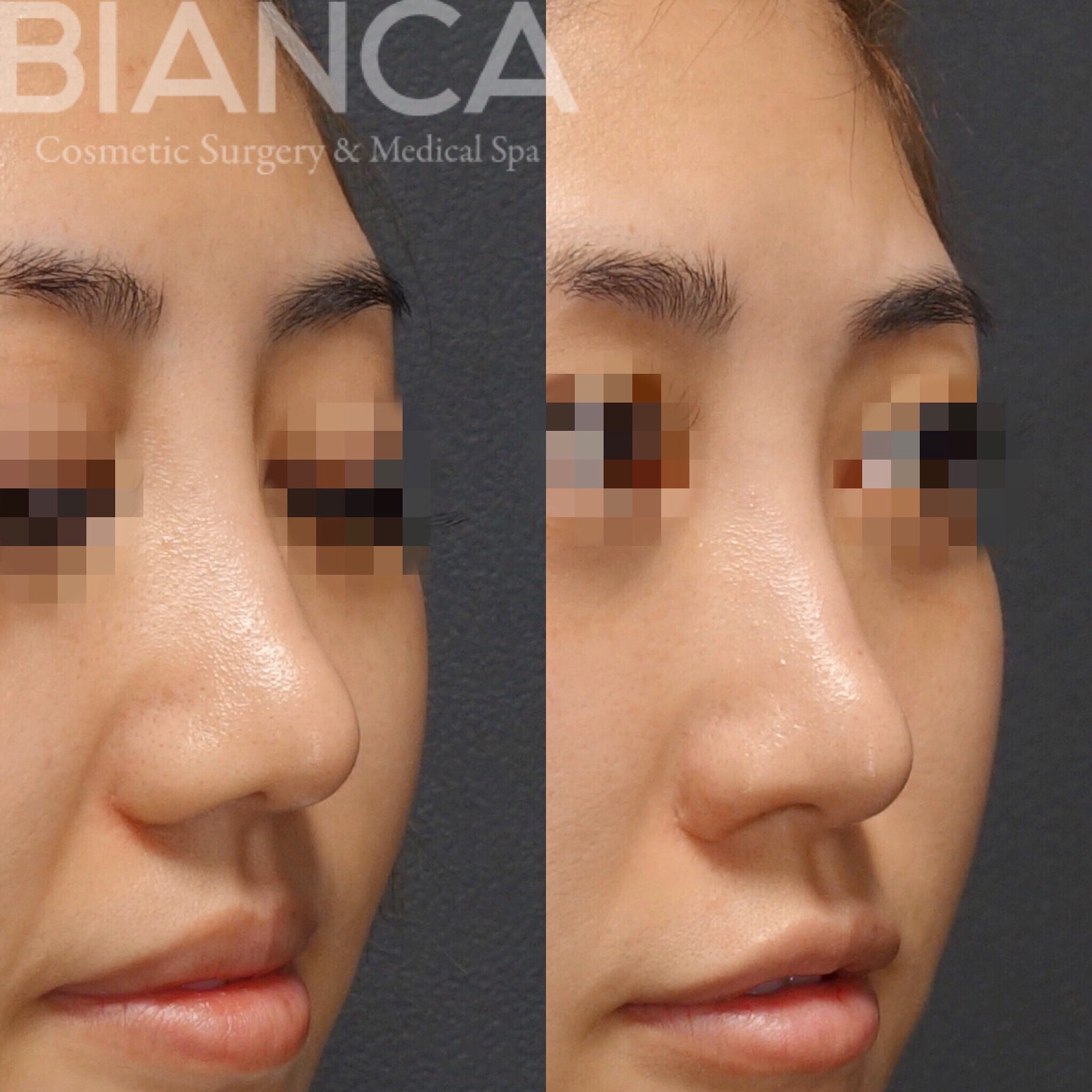 バービーさんも体験！ヴァンパイアフェイシャル！