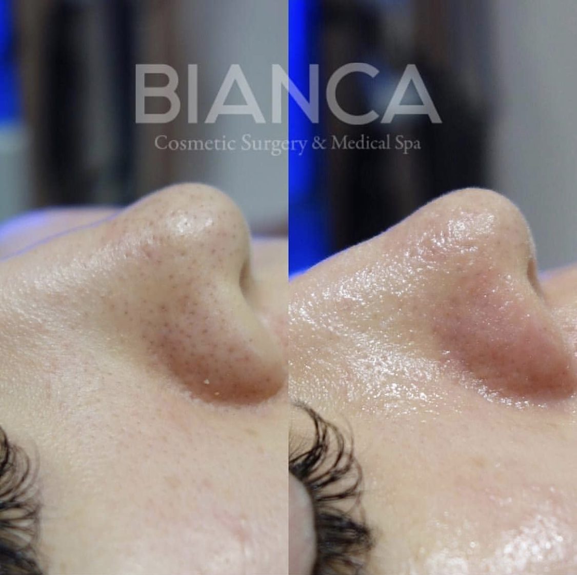 毛穴洗浄は今年の内に！リセットして、ツルピカお肌になろう✨✨️